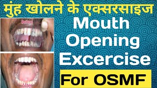 Mouth Opening Exercise | Home Remedial Exercise for OSMF Patients| Excellent Mouth Opening Exercise