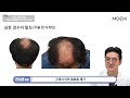 정수리 탈모가 무서운 진짜 이유는 모발이식 탈모 치료 전후 비교 ｜전지훈 원장｜모엠의원 moem