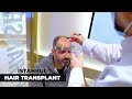 Best Hair Transplant - Hair Transplant 2024