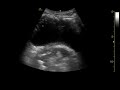 Point-of-care ultrasound demonstrating an air-fluid level of the urinary bladder