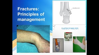 Principles of fracture management