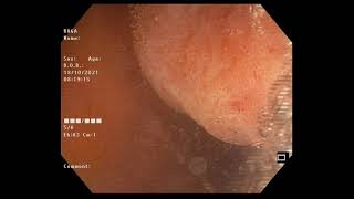 ileocecal intussusception