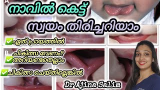 Self examination of Tongue tie malayalam | നാവിലെ കെട്ട് അറിയേണ്ടതെല്ലാം | Dr AjinaSalim #tonguetie