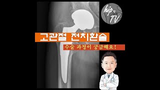 고관절 전치환술 과정 1분 안에 이해하기 #shorts