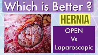 Hernia operation - OPEN vs LAPAROSCOPY