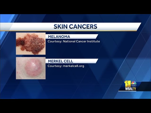 Melanoma Skin Cancer Stages
