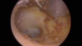 Ear Wax Removal in 'Shaky' Head - Mr Neel Raithatha (The Hear Clinic)