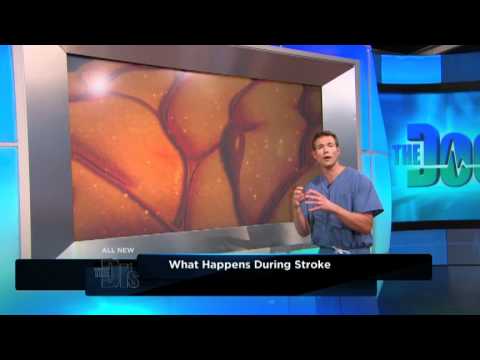Stroke Signs Stroke Signs