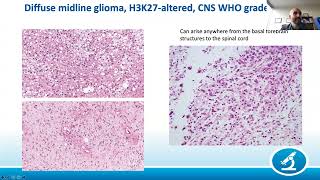 AANP Teaching Rounds - August 24 - Rare Gliomas