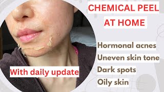 03Vlog||CHEMICAL PEEL AT HOME||JESSNERS||HORMONAL ACNE||DARK SPOTS