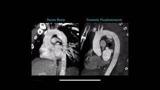 CT evaluation of Thoracic Trauma