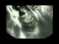 EUS FNA of Cholangiocarcinoma