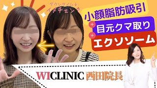 【小顔脂肪吸引+目元クマ取り】西田先生より大チェンジして頂いました！エクソソーム点滴でダウンタイムをビックリするぐらい短くする？！