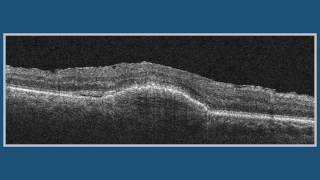 Subretinal Fluid (SRF) vs. Pigment Epithelium Detachment (PED)