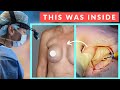 Breast Reconstruction After Lumpectomy Before And After Results