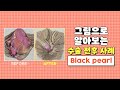 치질 수술 사례 ep 5 : black pearl | 항문질환 수술은 대장항문외과에서! | 서울GS항외과