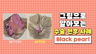 치질 수술 사례 ep 5 : black pearl | 항문질환 수술은 대장항문외과에서! | 서울GS항외과