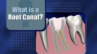 What is a Root Canal?