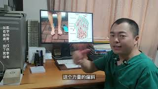 通过一个典型拇外翻来讲，条件许可大脚骨早手术更好-hallux valgus