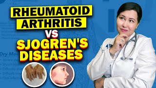 The Hidden Connection Between Rheumatoid Arthritis and Sjogren's Syndrome