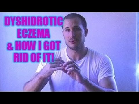 Little Bubbly Bumps On My Finger - Dyshidrotic Eczema & How I Got Rid of It! Little Bubbly Bumps On My Finger - Dyshidrotic Eczema & How I Got Rid of It!