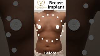 Transform to your Breast with Breast Implant | Breast Implant Surgery #shorts #ytshorts #hacks