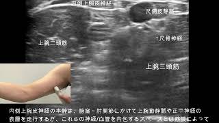 内側上腕・前腕皮神経の超音波観察