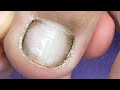 Massive  fungal toenails, Trimming  Fungal toenails of a diabetic patient