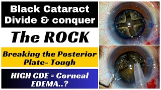 The Black Cataract PHACO - Strategies for The  ROCK...! - Dr. Deepak Megur