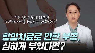 항암치료 후 부종, 불편함보다는 변한 얼굴 때문에 스트레스를 너무 받는다면