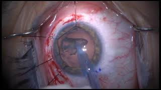 Traumatic Cataract with Iridodialysis