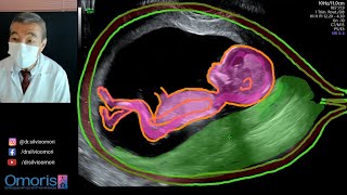 FETAL SEXING ନିଶ୍ଚିତ କରିବା | ପ୍ରସୂତି ଅଲଟ୍ରାସାଉଣ୍ଡ |