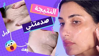 شد البشرة من غير عملية و لا ابر مع  خيوط الكولاجين  و البروتين  |  النتيجة صدمتني