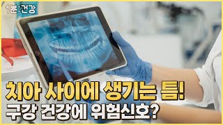 [1분 건강] 치아 사이에 생긴 틈! 구강 건강에 위험신호다?