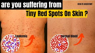 Symptoms Of Leukemia | Leukemia Tiny Red Spots On Skin | Chronic Myeloid Leukemi