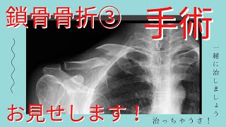 【鎖骨骨折③】手術の様子をお伝えします！