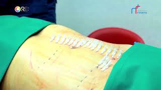 Non-surgical Abdomen Reduction Treatment with PDO threads