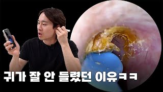 내 귀가 잘 안 들렸던 이유 ㅋㅋ｜귀내시경｜귀지제거영상｜귀청소