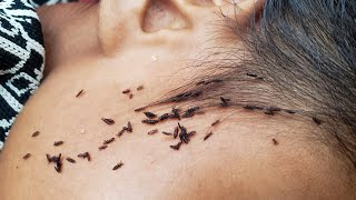 Remove all a lot of lice from short hair - Getting out all of big lice