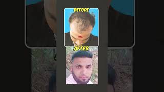 💥 வழுக்கை தலை பிரச்சினைக்கு FREE HAIR TRANSPLANT ஆ!!! 💥