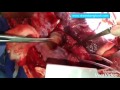 repair of tracheo esophageal fistula in adults with esophagectomy