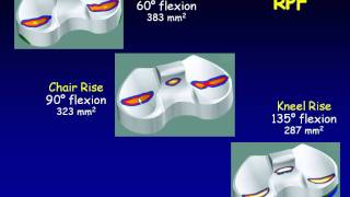 Contact Stress and Kinematics of Mobile Bearing TKA