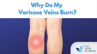 Why Do My Varicose Veins Burn?