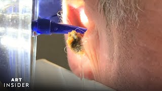 Water Device Painlessly Removes Earwax