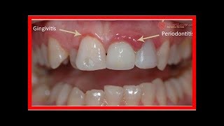 Voici Les Bons Remèdes Maison Pour Soigner Les Gencives Et Guérir Les Caries Naturellement …