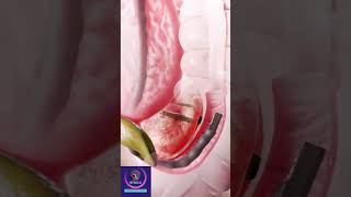 Stone Removal from Bile Ducts - ERCP Procedure