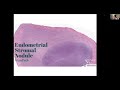 Mesenchymal Tumors of the Uterus, part 2- Hospital 103 series