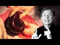 Bowel Ischemia - trailer