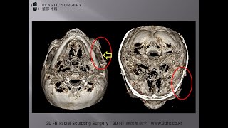 광대수술후 발생한 광대과교정과 광대통증에 대해서