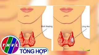 THVL | Thực hư việc dư i-ốt trong thức ăn gây bệnh cường giáp